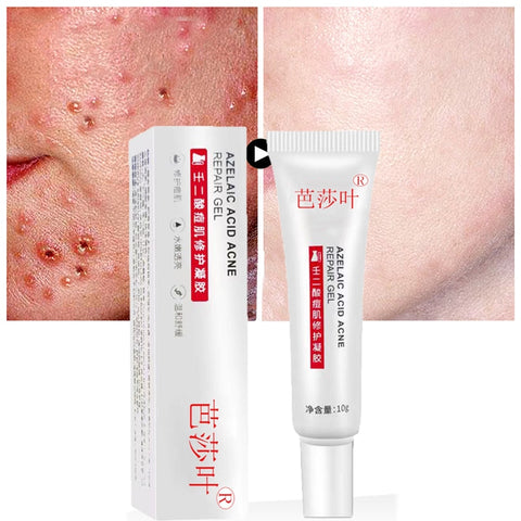 7 Days Azelaic Acid Acne Removal Cream Fade Acne Spots Oil Control Anti-Acne Shrink Pores Acne Treatment Cream Face Gel Skin Car image